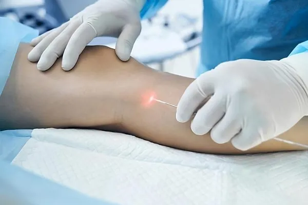 Endolift
